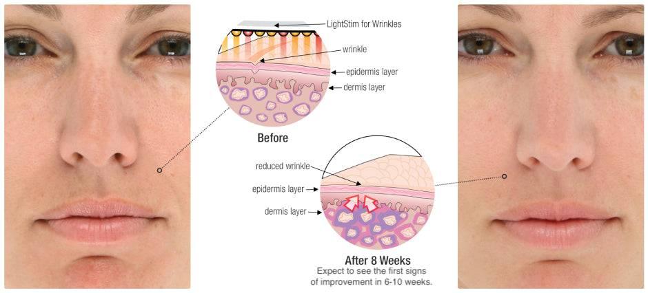 LightStim For Wrinkles LED Anti Aging Therapy White