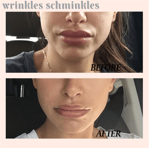 Wrinkles Schminkles Mouth & Lip Smoothing Kit