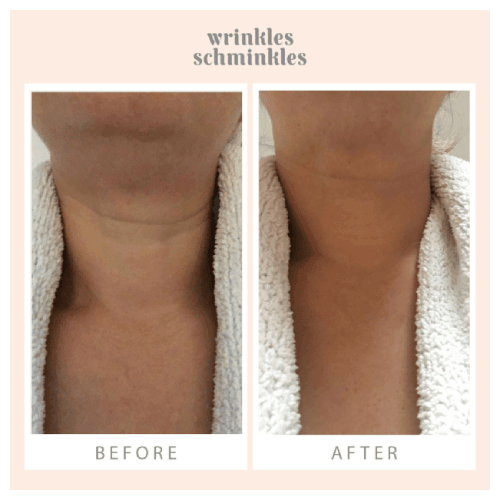 Wrinkles Schminkles Neck Smoothing Kit