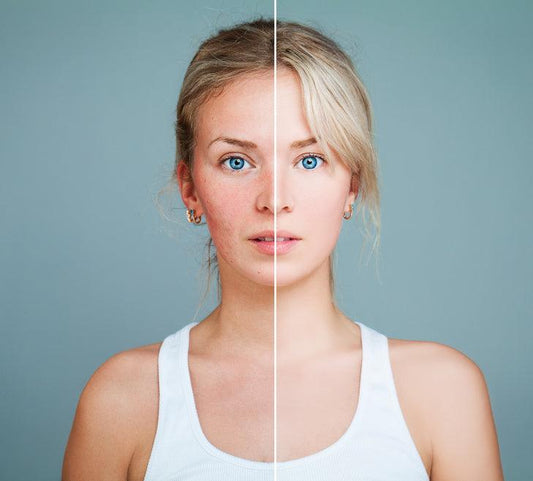 How To Treat Sun Damaged Skin