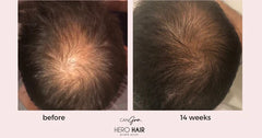 Can Gro Advanced Hair Growth System