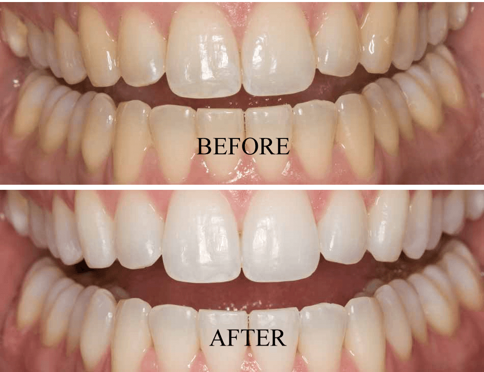 Santorini Smile Teeth Whitening Teeth Whitening Box.