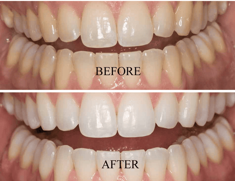 Santorini Smile Teeth Whitening Teeth Whitening Box.