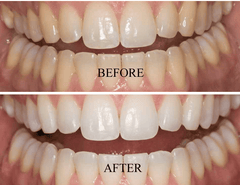 Santorini Smile Teeth Whitening Teeth Whitening Box.