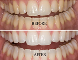 Santorini Smile Teeth Whitening Complete Take Home Collection.