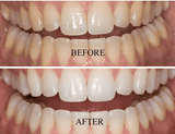 Santorini Smile PEN Carbamide Peroxide 18% Whitening Pen x 5.