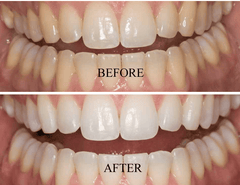 Santorini Smile PEN Carbamide Peroxide 18% Whitening Pen x 5.